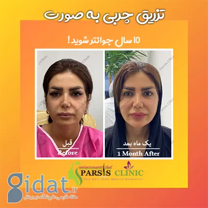 لیفت و جوانسازی صورت در کرج و هزینه آن|کلینیک تخصصی پارسیس